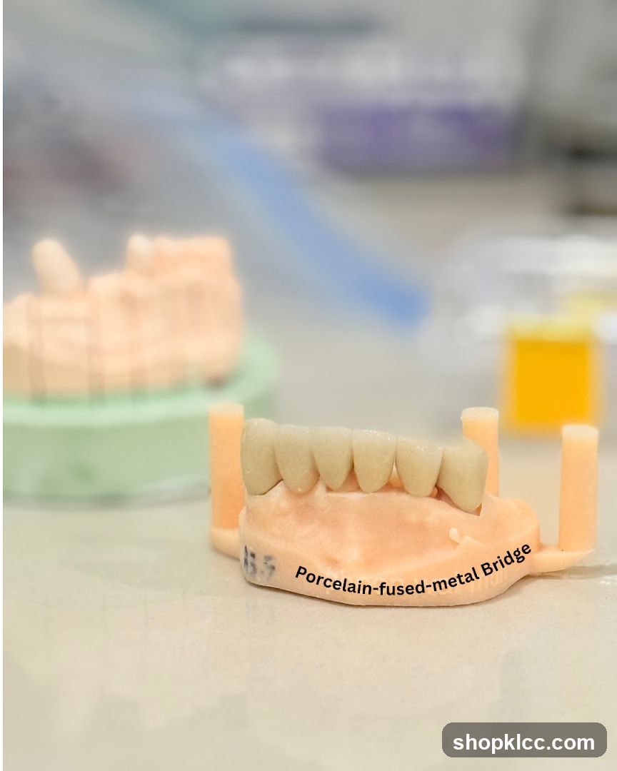 Dental Prosthetic Model