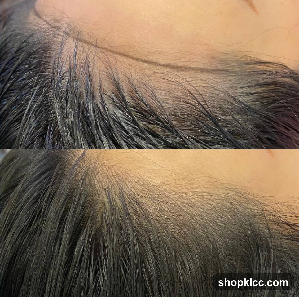 Before and After Hairline Treatment