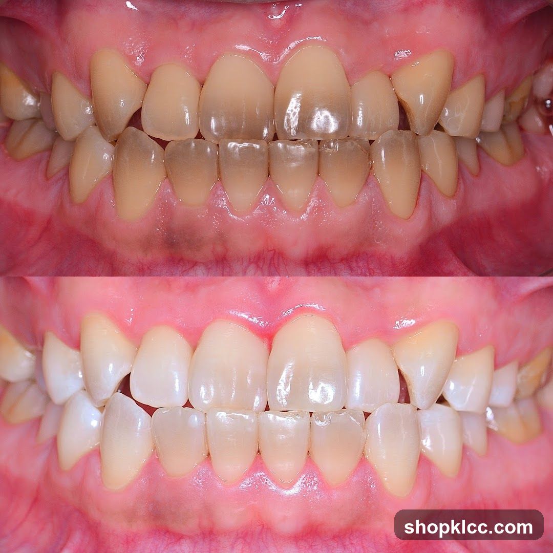Before and After Teeth Whitening