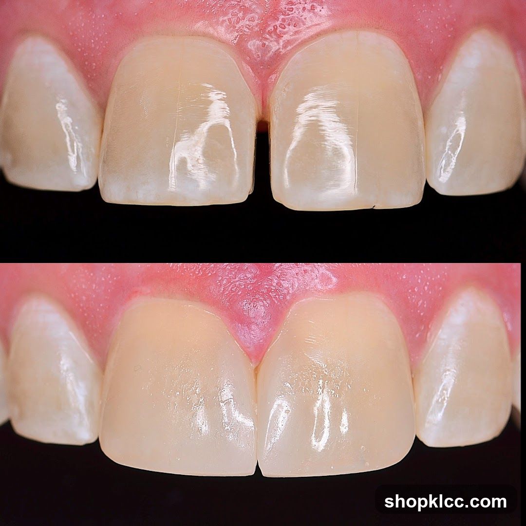 Dental Veneers