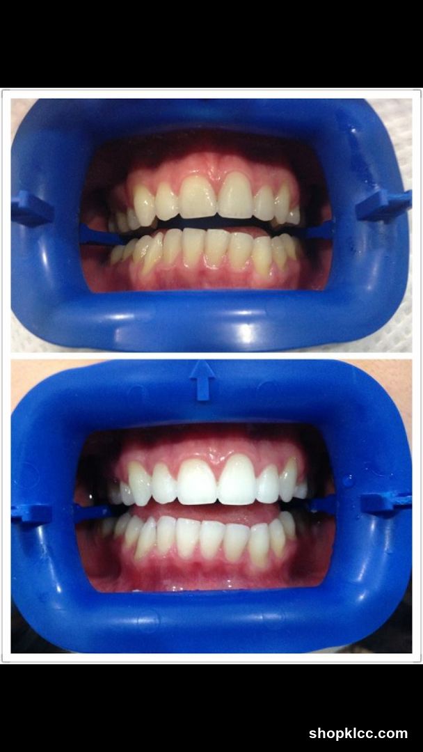Dental Treatment Before and After