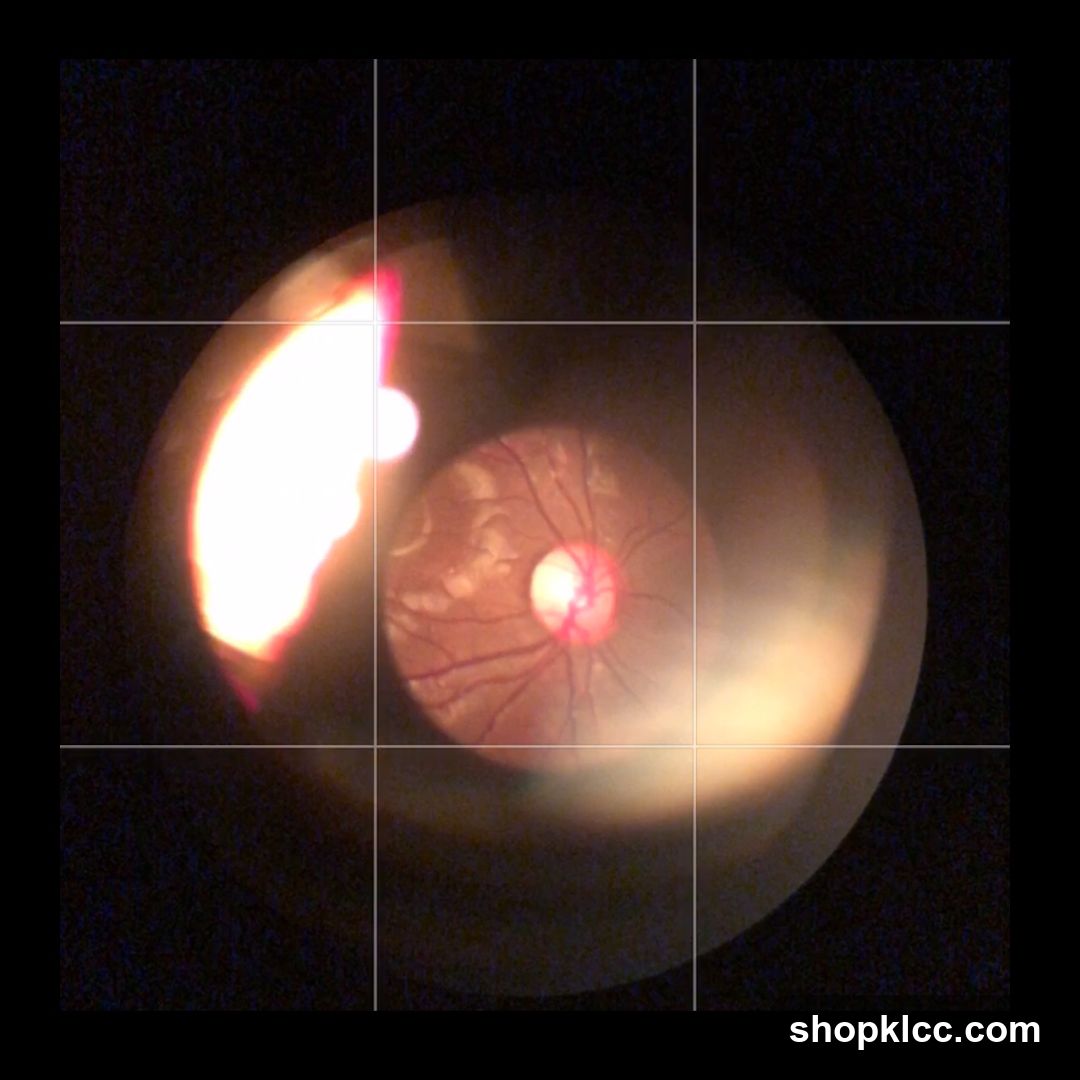 Ophthalmoscopic Image of the Retina