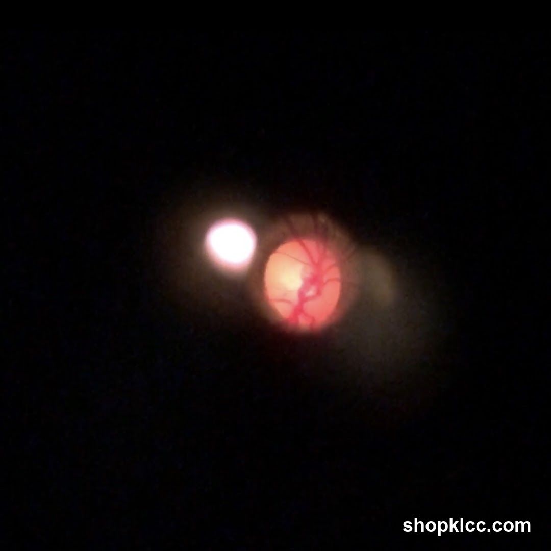 Ophthalmoscope View