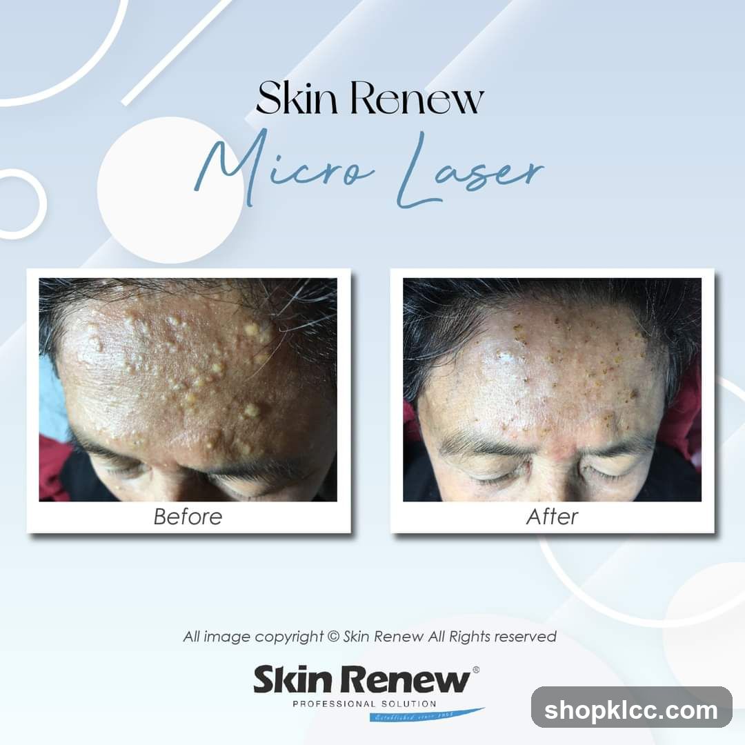 Skin Renew Micro Laser Before and After