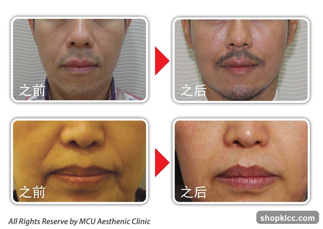 Before and After Cosmetic Procedure