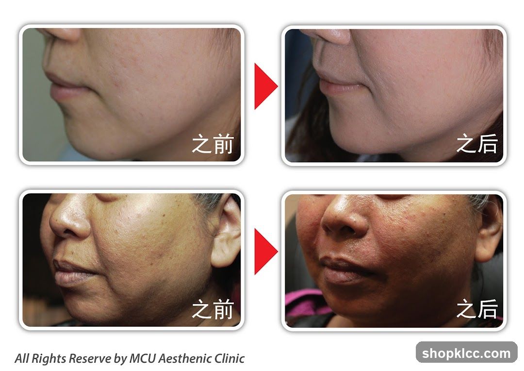 Before and After Cosmetic Treatment