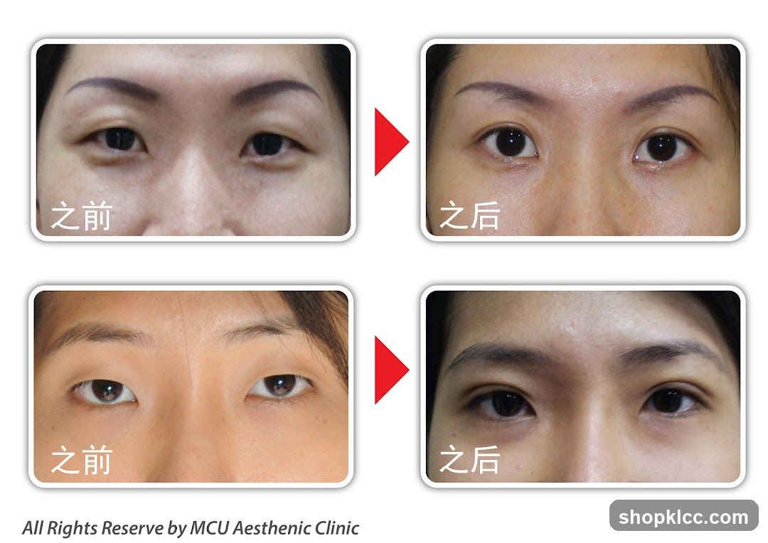 Before and After Eye Surgery
