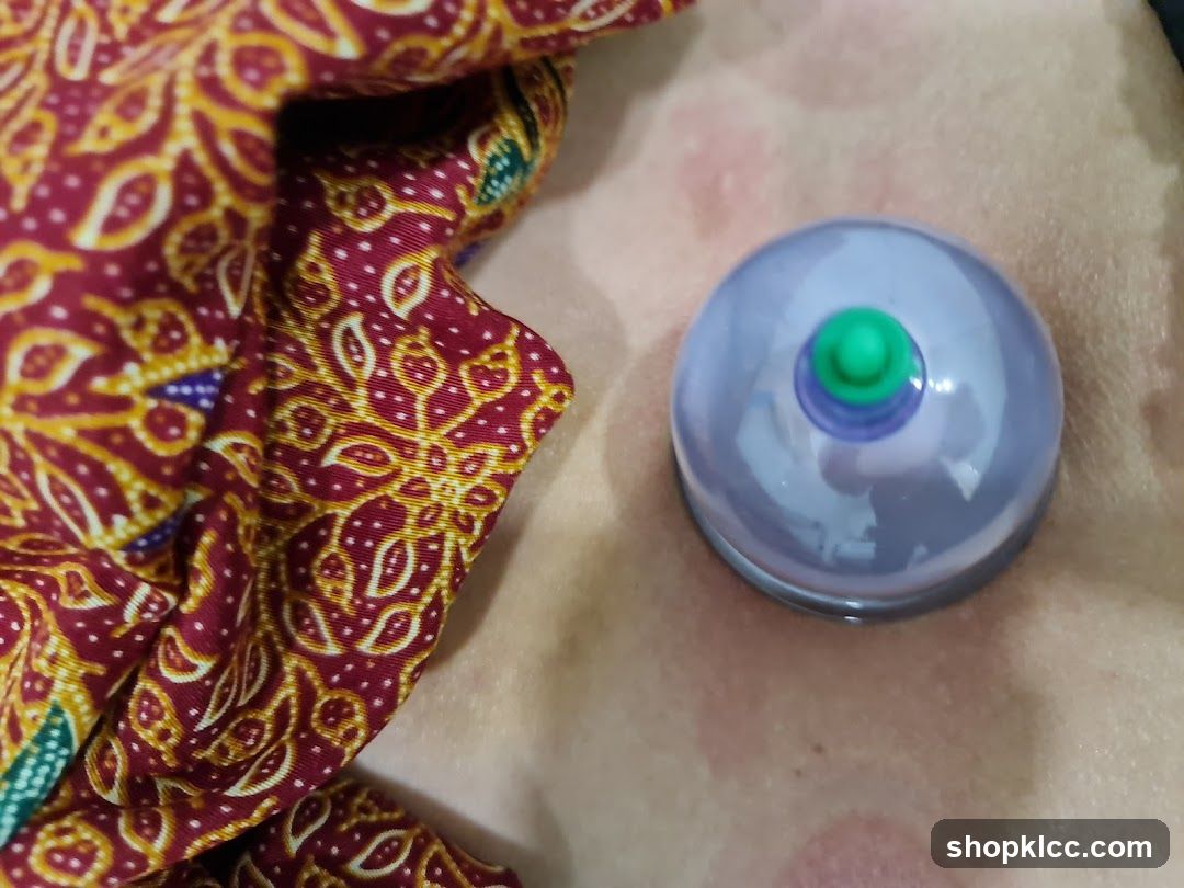 Cupping Therapy on Skin