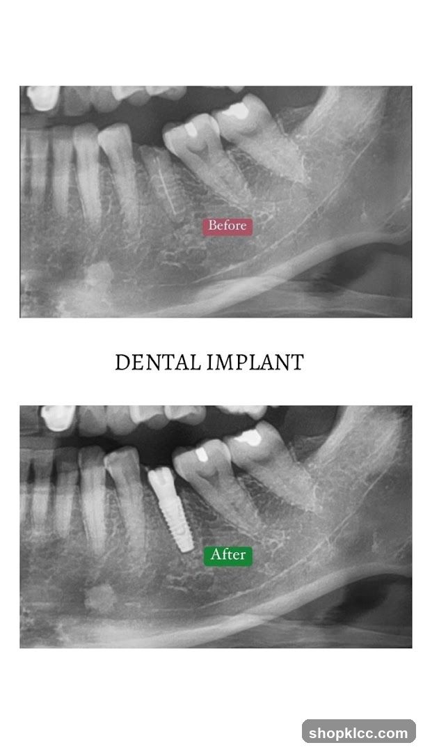 Dental Implant X-ray Comparison