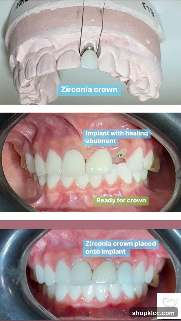 Dental Implant and Zirconia Crown Process