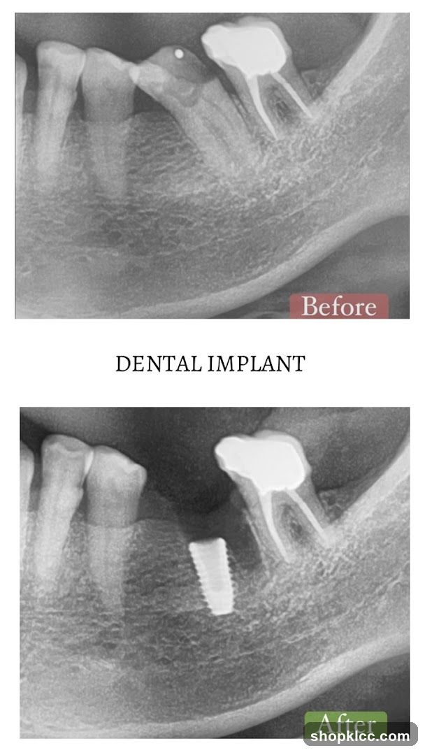 Dental Implant X-Ray Comparison