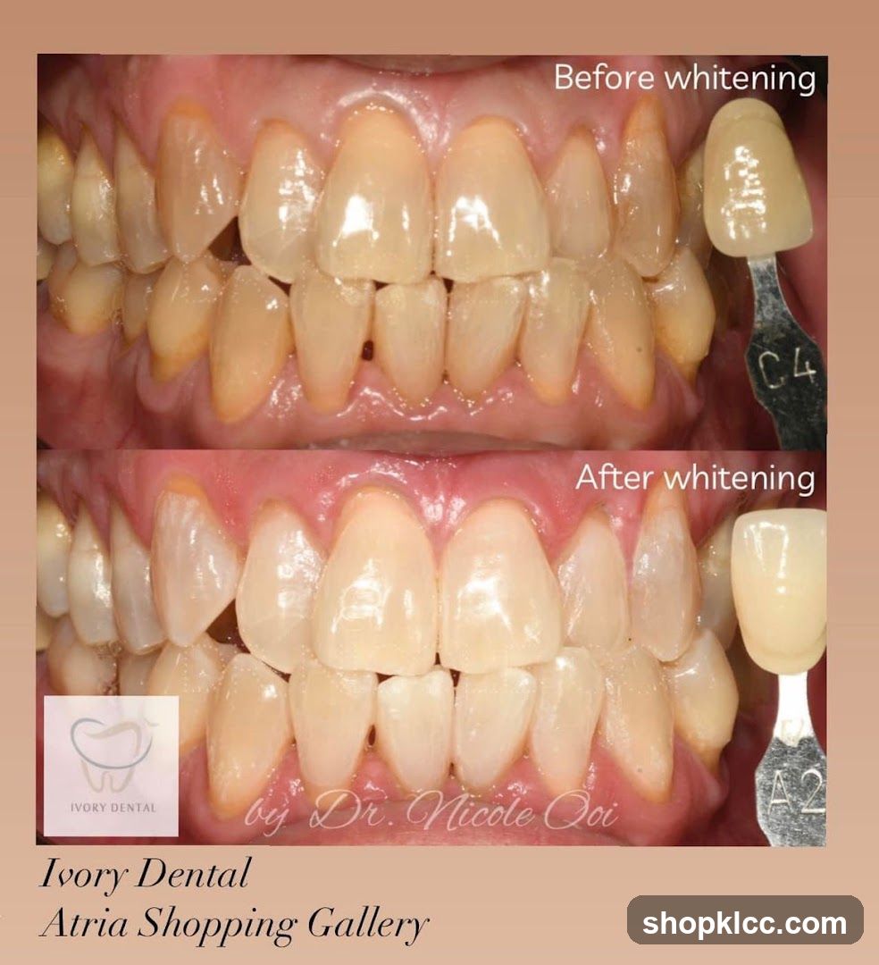 Dental Whitening Before and After