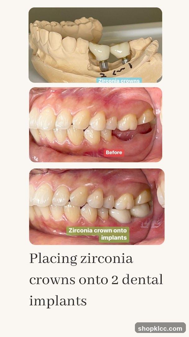 Placing zirconia crowns onto 2 dental implants