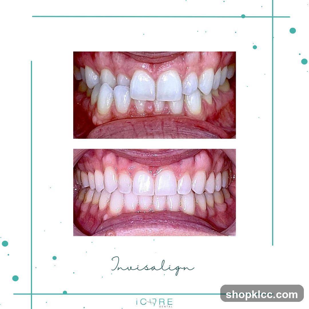 Invisalign Before and After