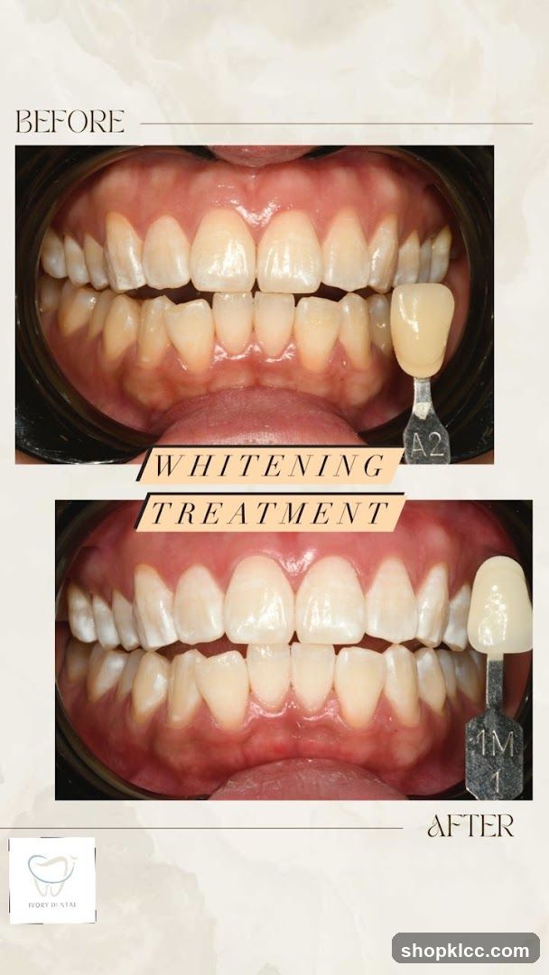 Teeth Whitening Treatment Before and After