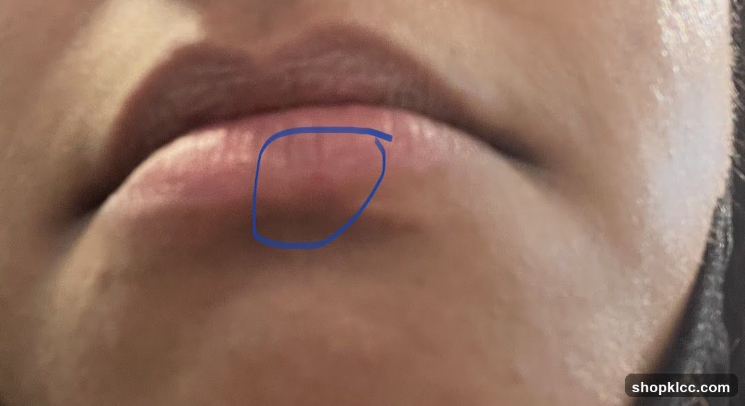 Lip Swelling