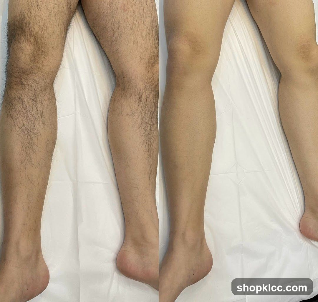 Leg Hair Removal Before and After