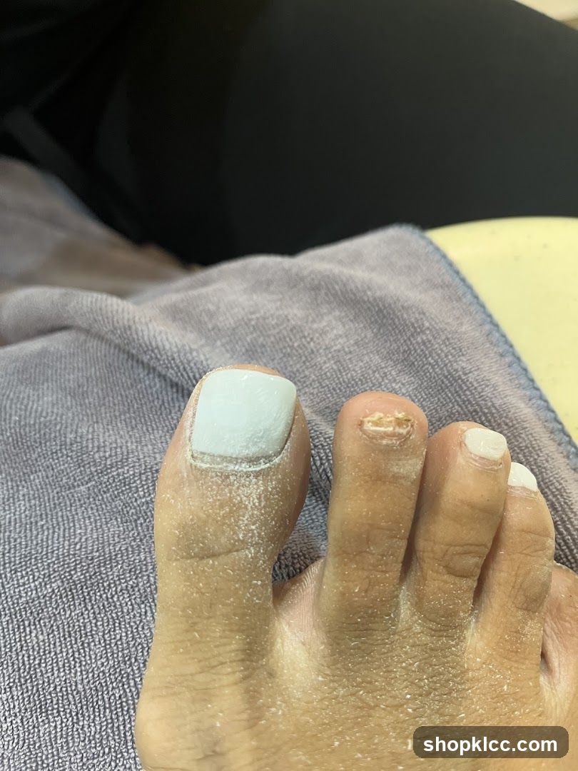 Foot with damaged toenail