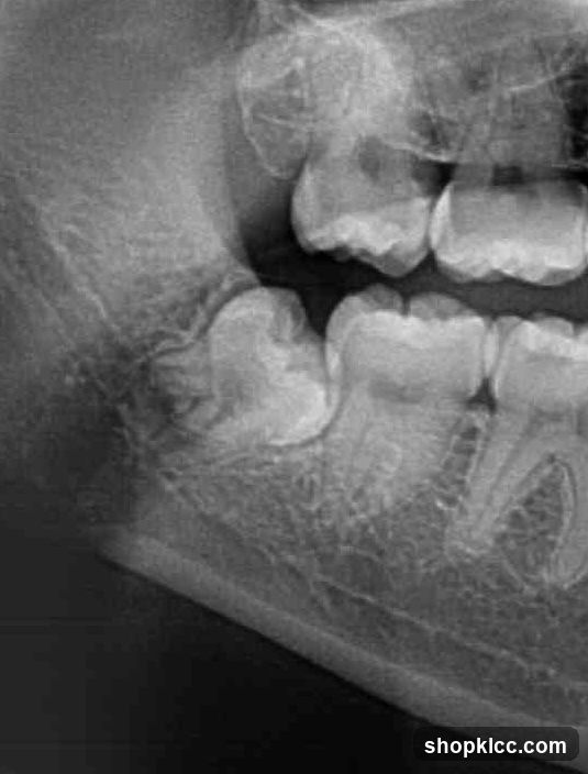 Dental X-ray