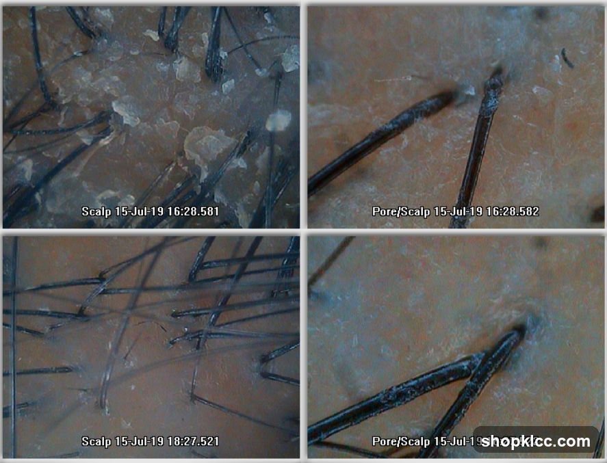 Dermatoscopy of Scalp and Pore