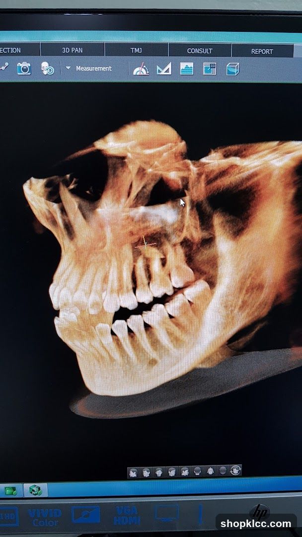 3D CT Scan of Skull