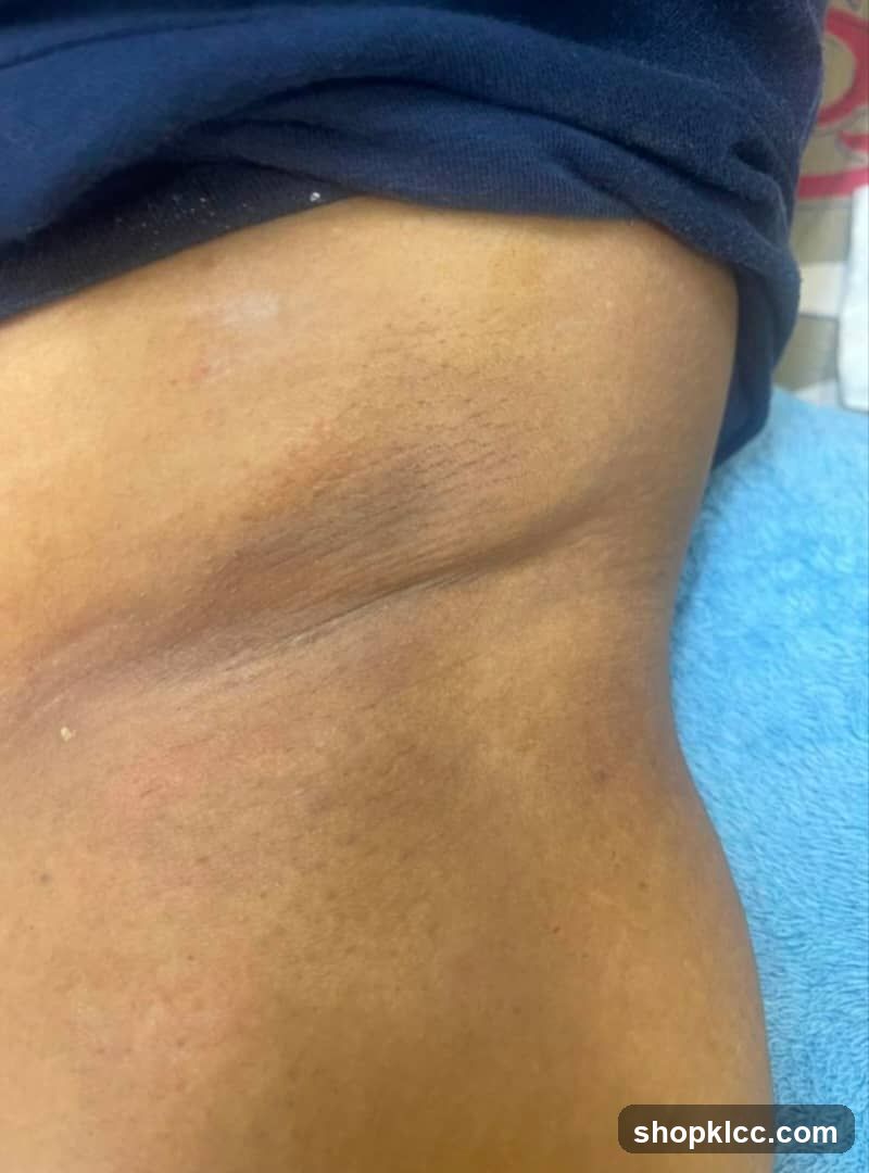 Skin Condition on Abdomen