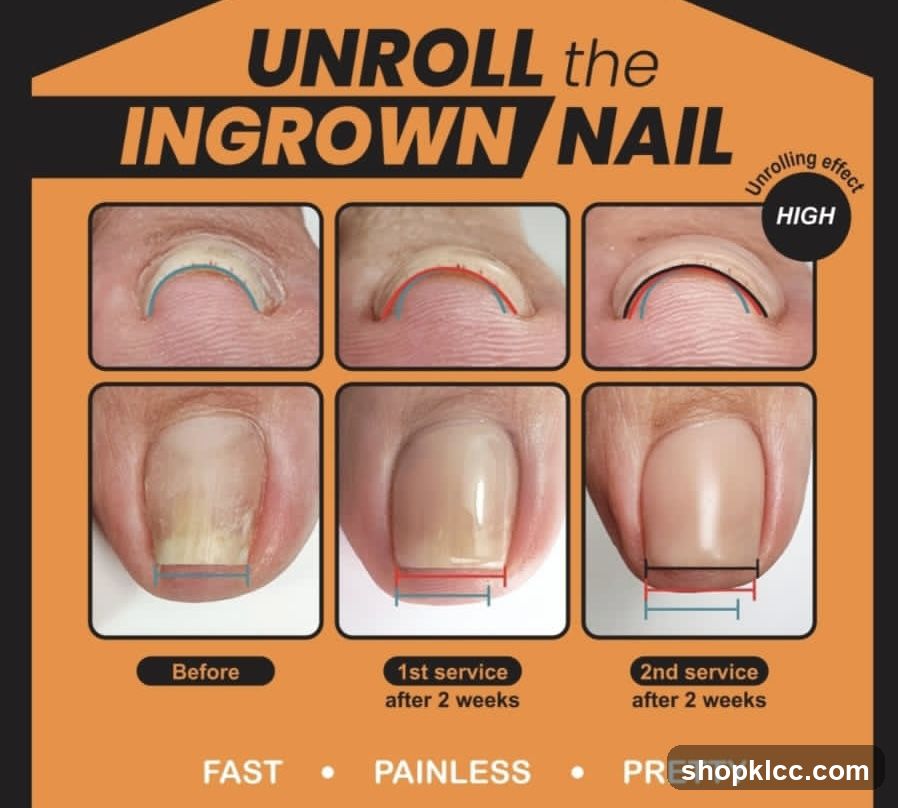 Unroll the Ingrown Nail