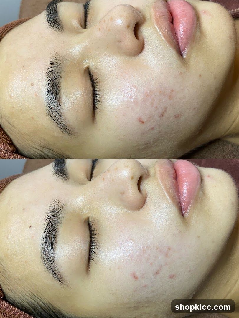 Before and After Facial Treatment