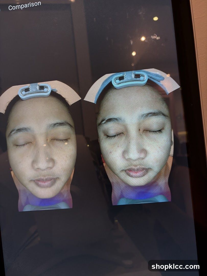Comparison of facial skin condition with clips on forehead