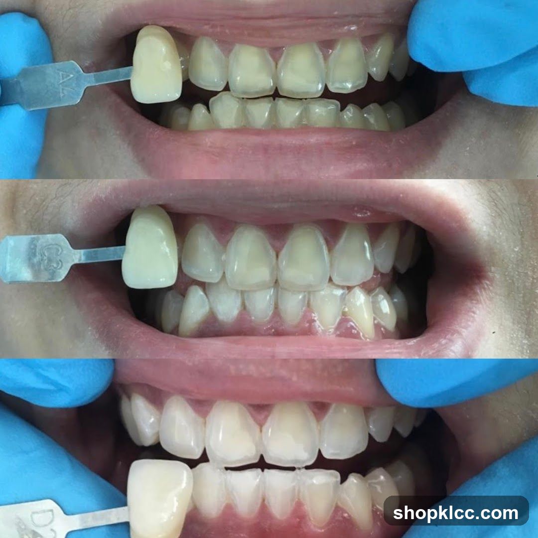 Dental Shade Selection