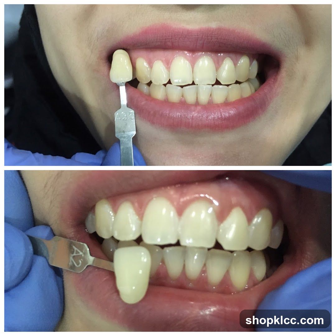 Dental Shade Selection