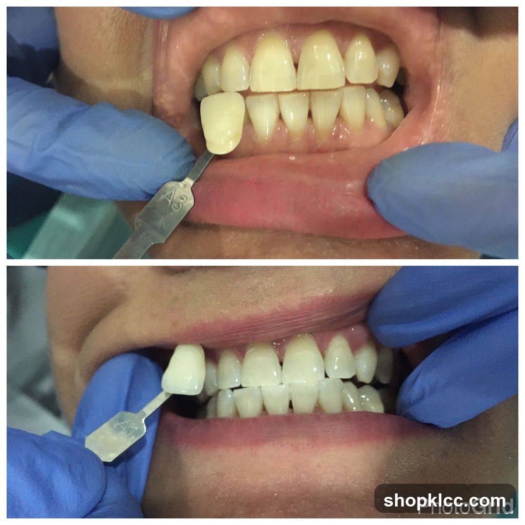 Dental Shade Selection