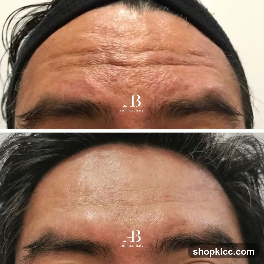Forehead skin comparison before and after treatment