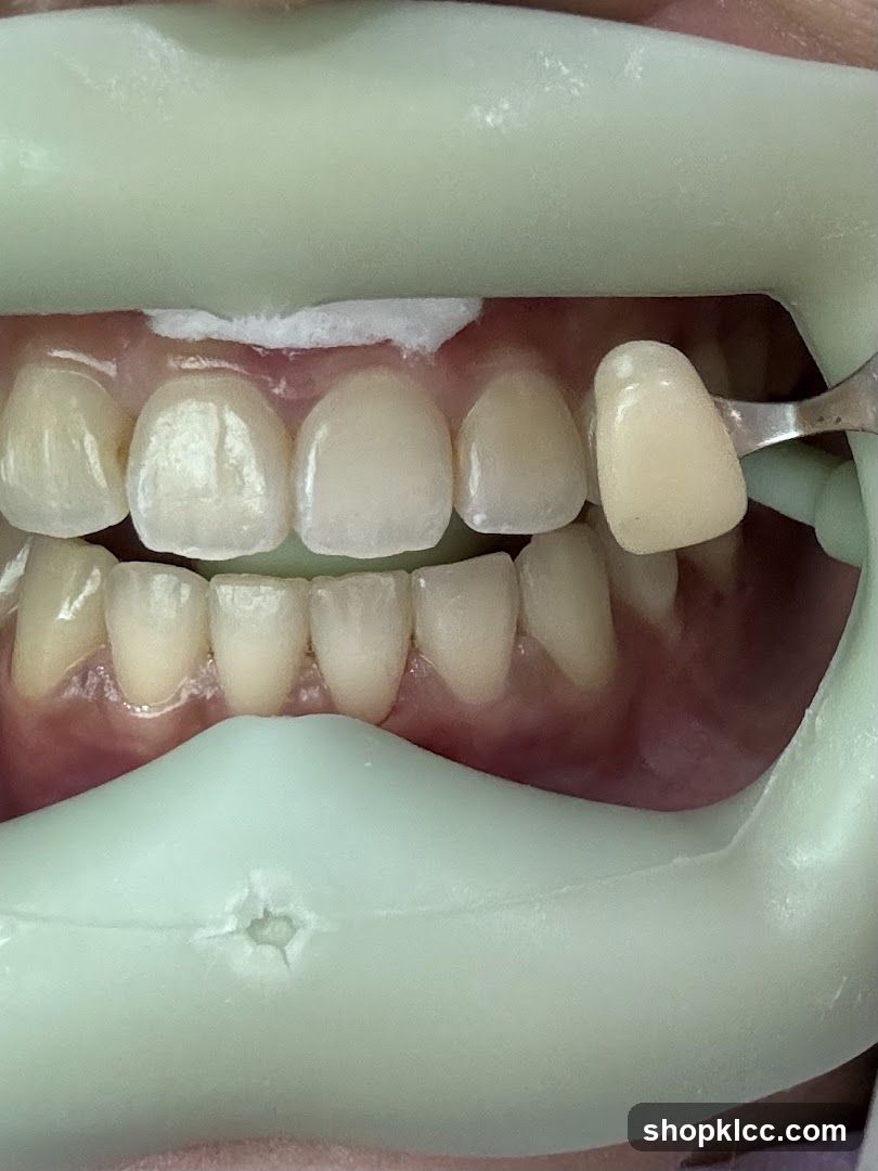 Dental Shade Matching