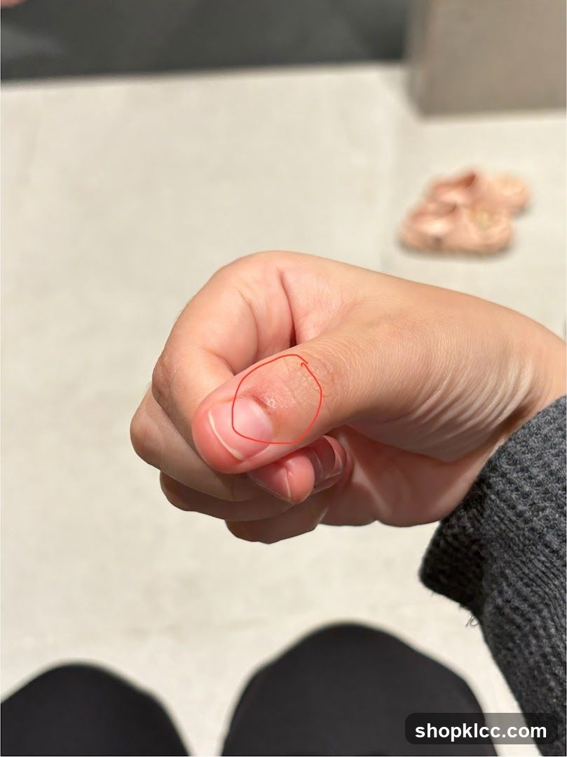 Close-up of a thumb with a red circle highlighting a small blister or irritation.