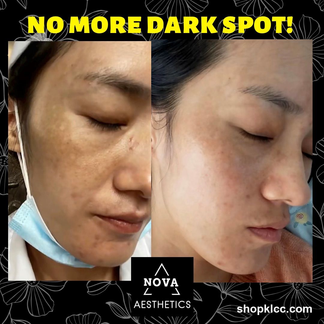 Before and After Dark Spot Treatment