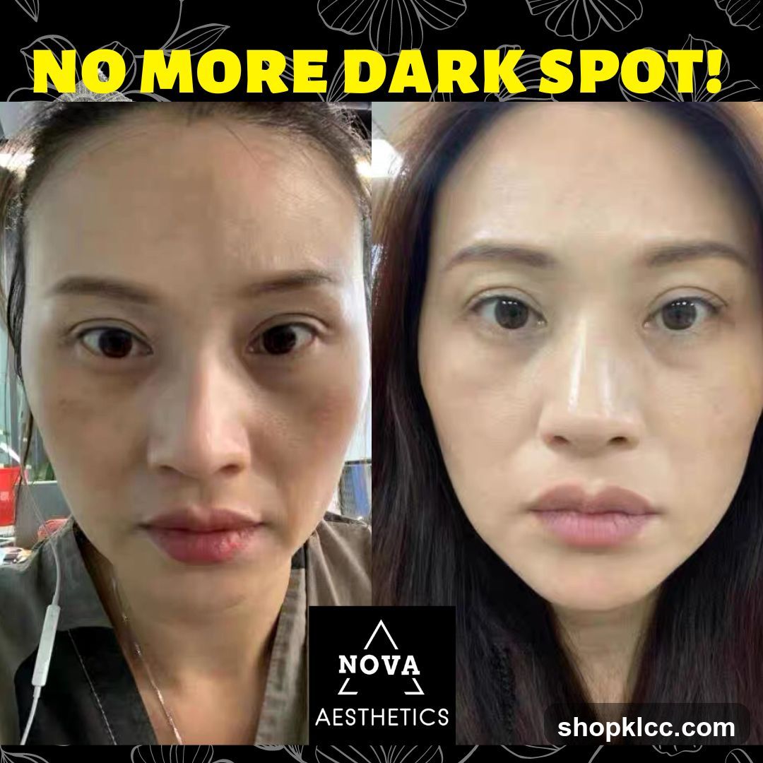 Before and After Skin Treatment