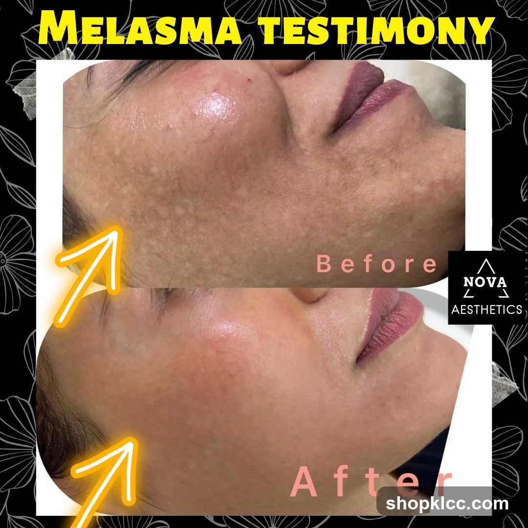 Melasma Testimony