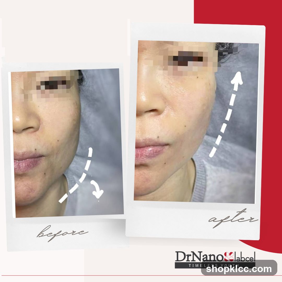 Before and After Facial Treatment