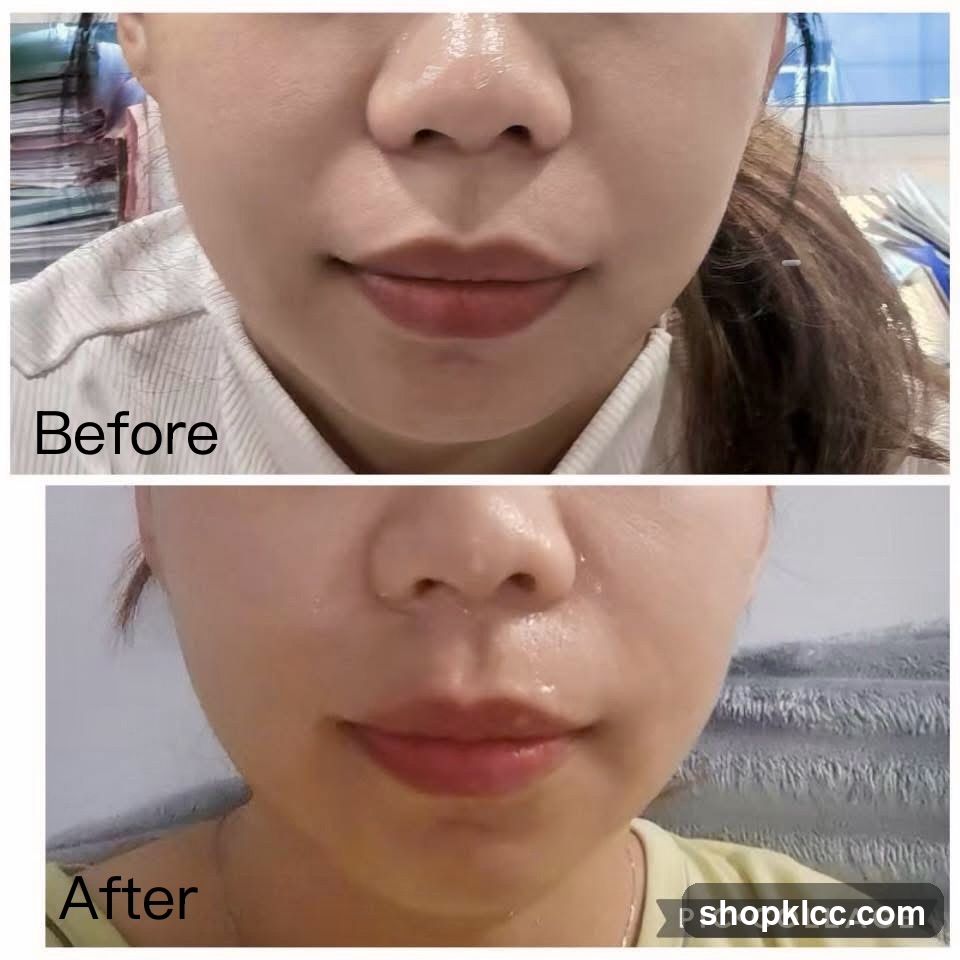 Before and After Facial Comparison
