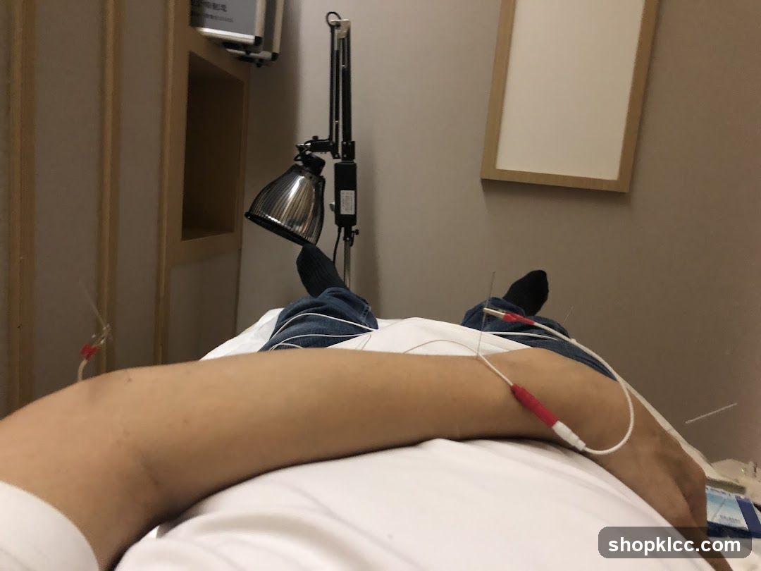 Acupuncture treatment