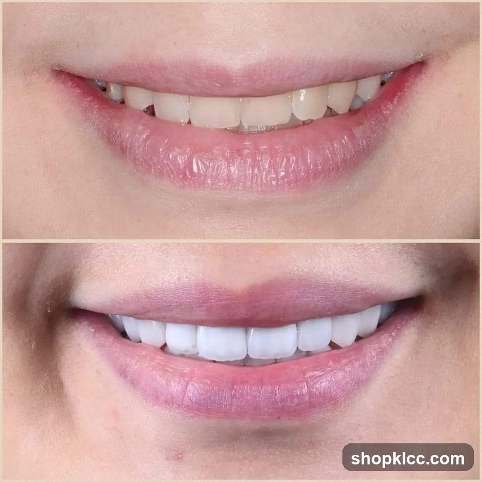 Smile Transformation