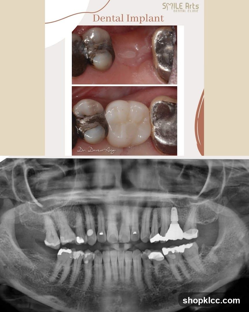Dental Implant Case Study