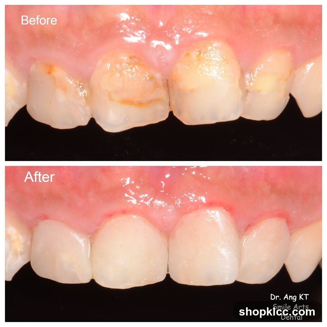 Before and After Dental Treatment