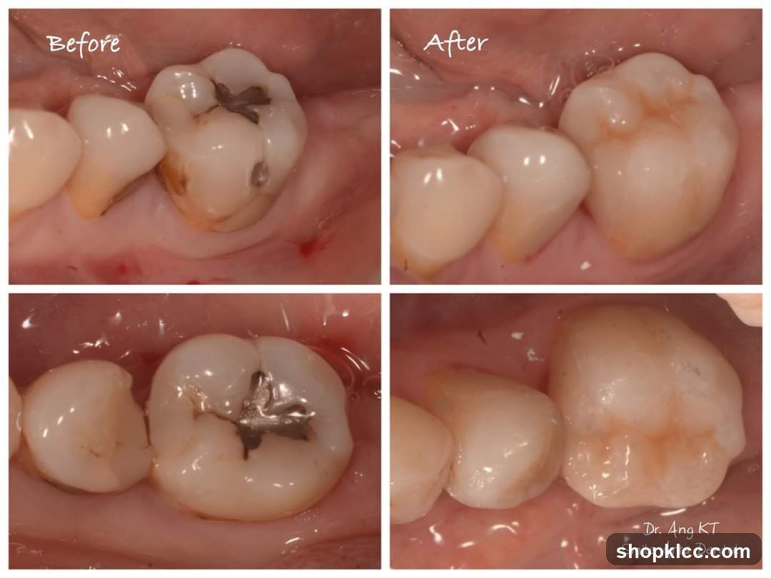 Dental Restoration Before and After