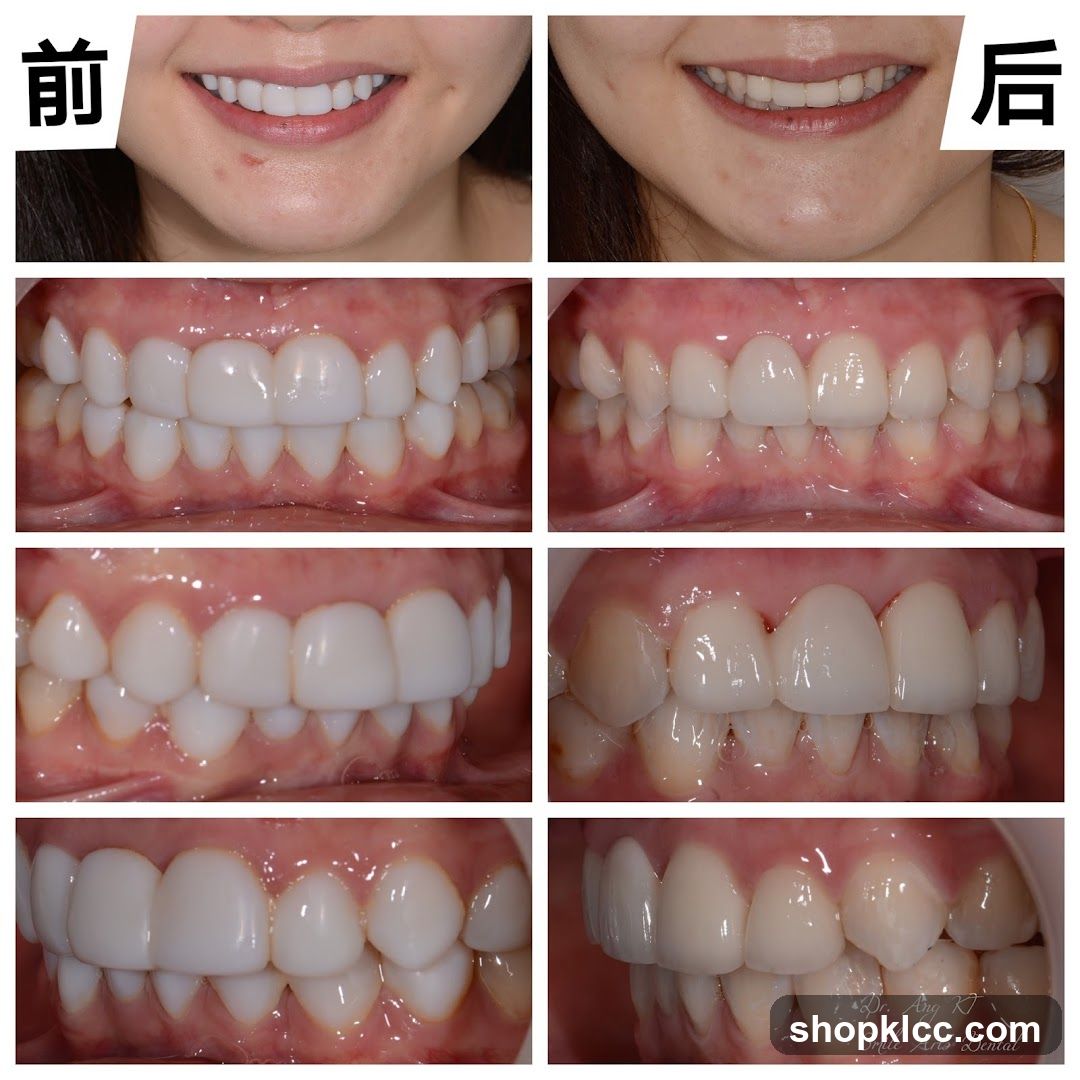 Before and After Dental Treatment Comparison
