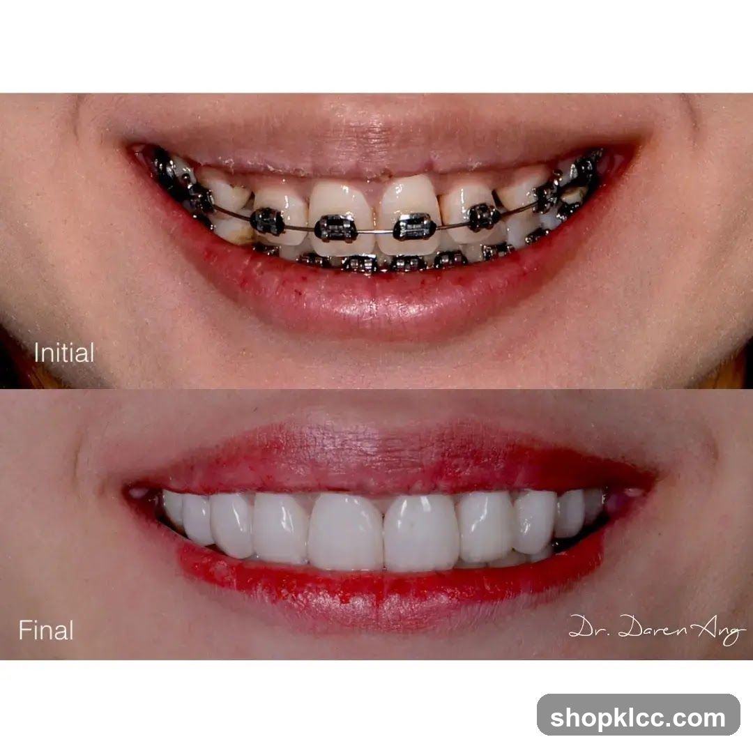 Teeth Whitening Before and After