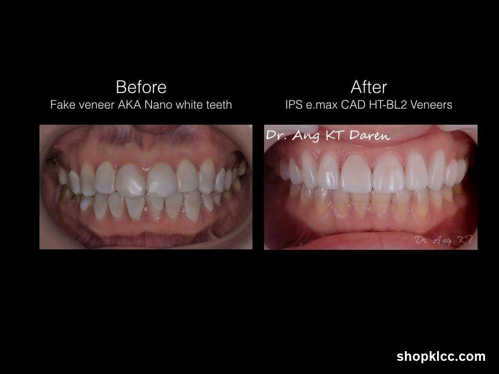 Before and After Dental Veneers Comparison