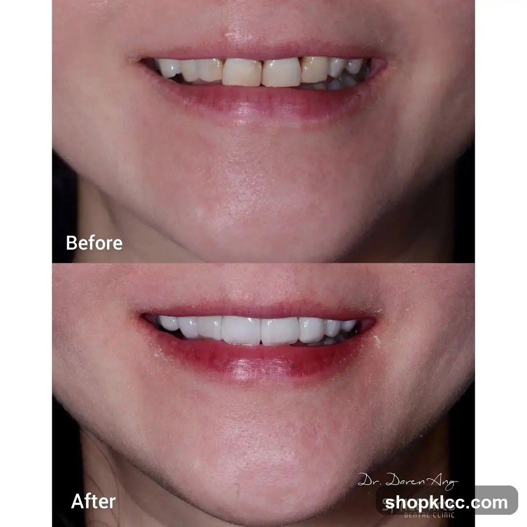Before and After Dental Smile Transformation