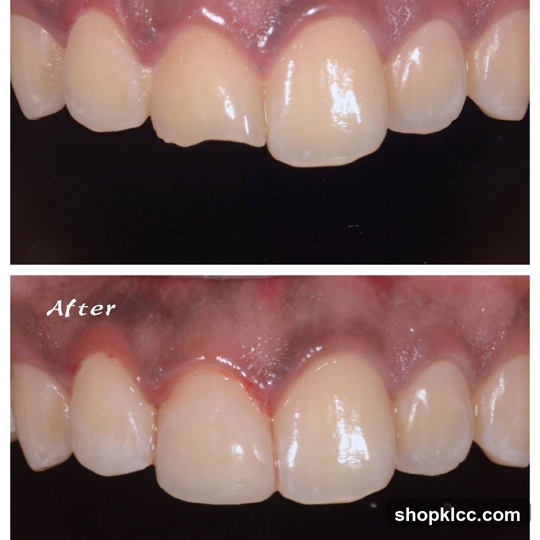 Dental Restoration Comparison